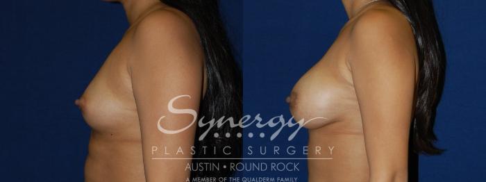 Before & After Breast Augmentation Case 100 View #3 View in Austin, TX