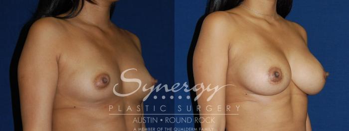 Before & After Breast Augmentation Case 100 View #4 View in Austin, TX