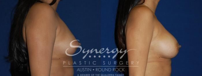 Before & After Breast Augmentation Case 100 View #5 View in Austin, TX