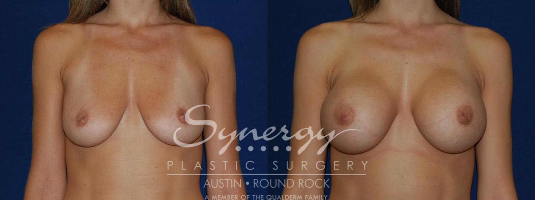 Before & After Breast Augmentation Case 104 View #1 View in Austin, TX