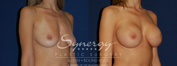Before & After Breast Augmentation Case 104 View #2 View in Austin, TX