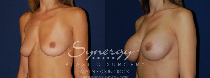 Before & After Breast Augmentation Case 104 View #3 View in Austin, TX