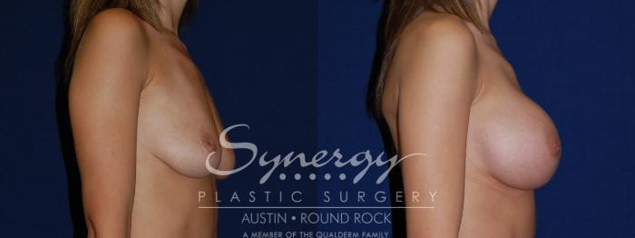 Before & After Breast Augmentation Case 104 View #4 View in Austin, TX