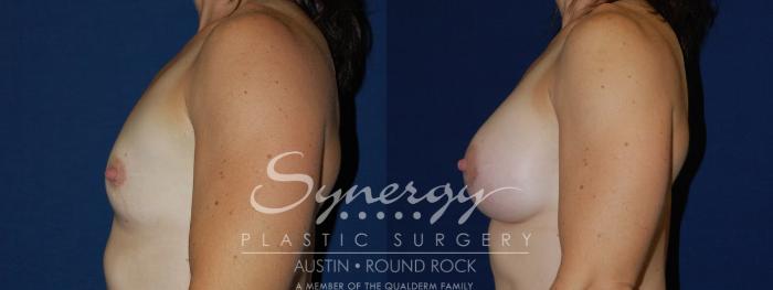 Before & After Breast Augmentation Case 108 View #1 View in Austin, TX