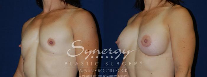Before & After Breast Augmentation Case 108 View #2 View in Austin, TX