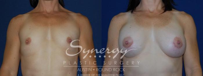 Before & After Breast Augmentation Case 108 View #3 View in Austin, TX