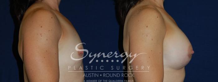 Before & After Breast Augmentation Case 108 View #4 View in Austin, TX