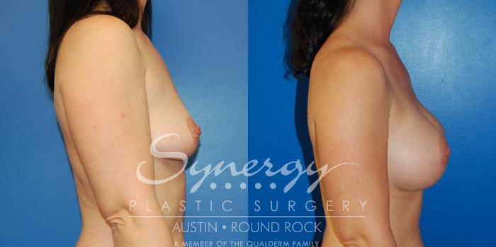 Before & After Breast Augmentation Case 11 View #10 View in Austin, TX
