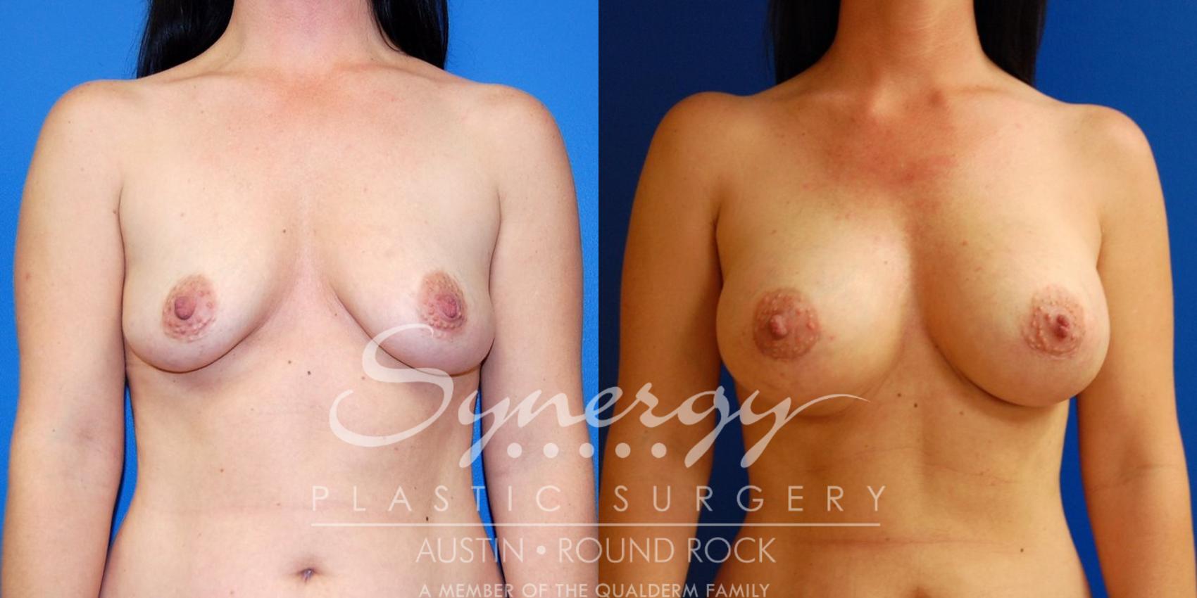 Before & After Breast Augmentation Case 11 View #6 View in Austin, TX