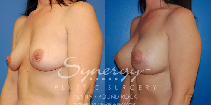 Before & After Breast Augmentation Case 11 View #7 View in Austin, TX