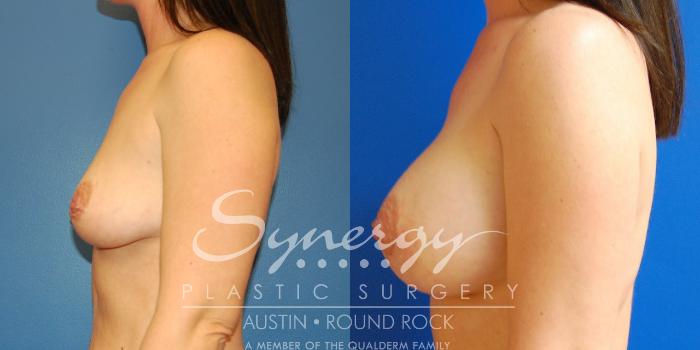 Before & After Breast Augmentation Case 11 View #9 View in Austin, TX