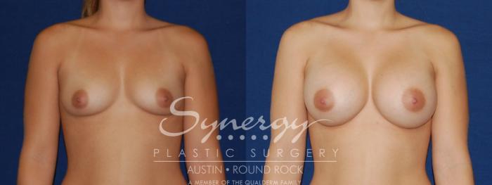 Before & After Breast Augmentation Case 117 View #1 View in Austin, TX