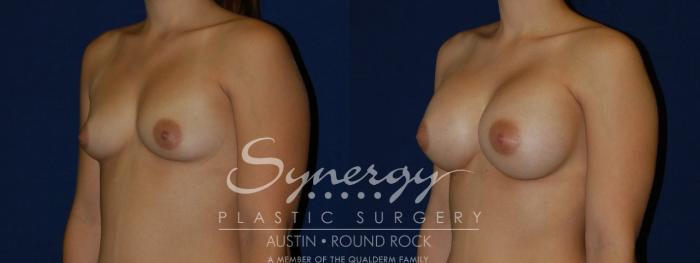 Before & After Breast Augmentation Case 117 View #2 View in Austin, TX