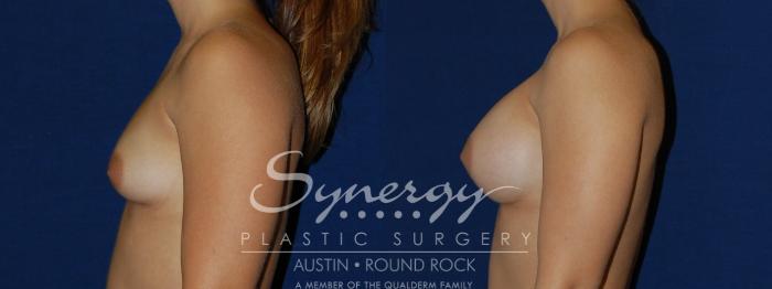 Before & After Breast Augmentation Case 117 View #3 View in Austin, TX