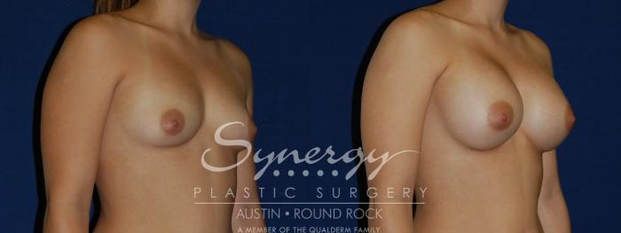 Before & After Breast Augmentation Case 117 View #4 View in Austin, TX