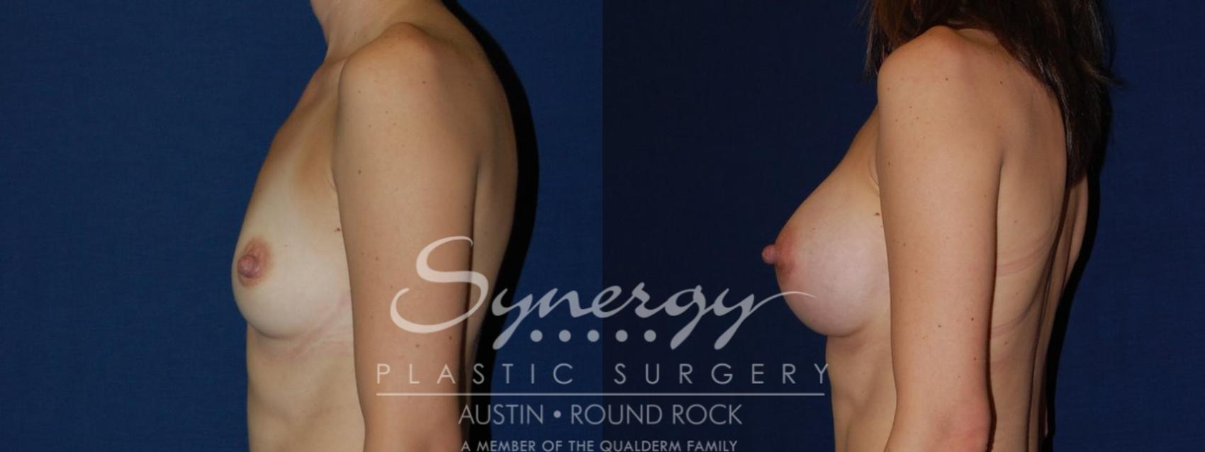 Before & After Breast Augmentation Case 119 View #1 View in Austin, TX