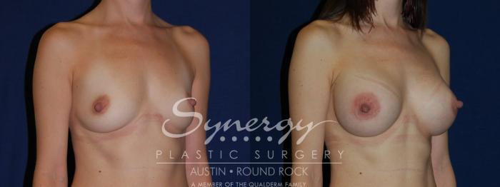Before & After Breast Augmentation Case 119 View #2 View in Austin, TX