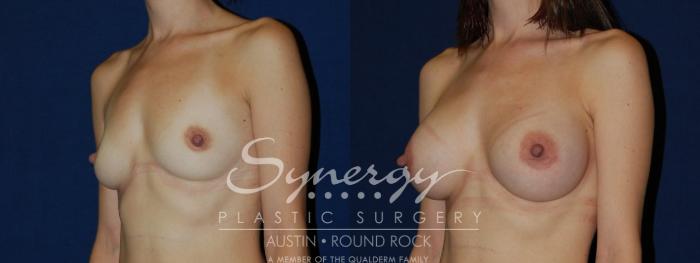 Before & After Breast Augmentation Case 119 View #3 View in Austin, TX