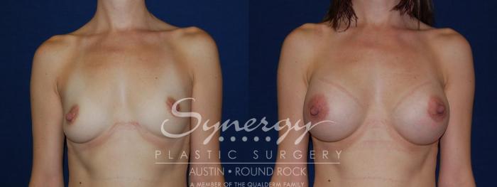 Before & After Breast Augmentation Case 119 View #4 View in Austin, TX