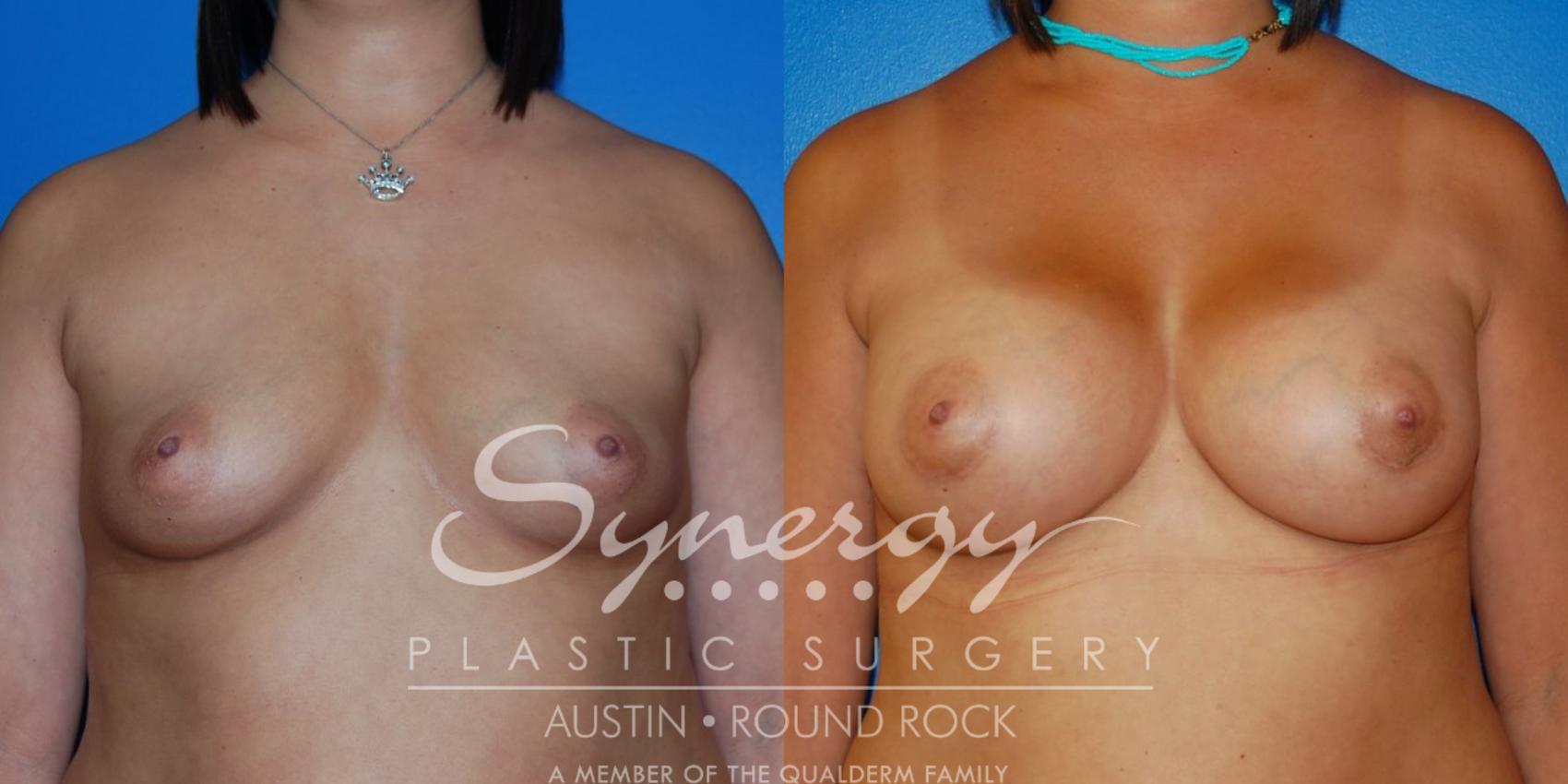 Before & After Breast Augmentation Case 12 View #4 View in Austin, TX