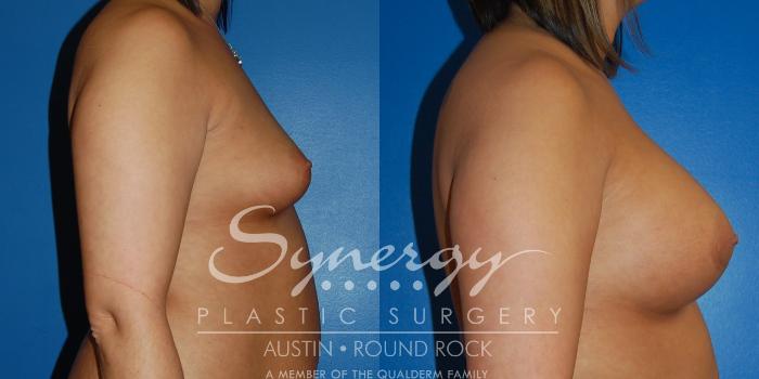 Before & After Breast Augmentation Case 12 View #5 View in Austin, TX