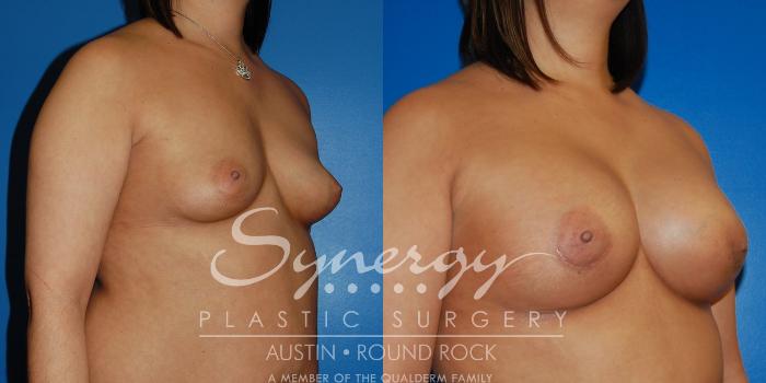 Before & After Breast Augmentation Case 12 View #6 View in Austin, TX