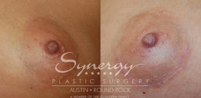 Before & After Breast Augmentation Case 12 View #7 View in Austin, TX