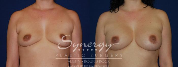 Before & After Breast Augmentation Case 121 View #1 View in Austin, TX