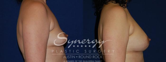 Before & After Breast Augmentation Case 121 View #2 View in Austin, TX