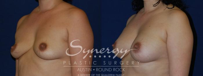 Before & After Breast Augmentation Case 121 View #3 View in Austin, TX