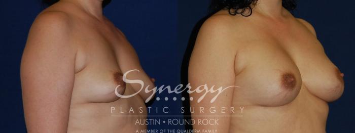 Before & After Breast Augmentation Case 121 View #4 View in Austin, TX