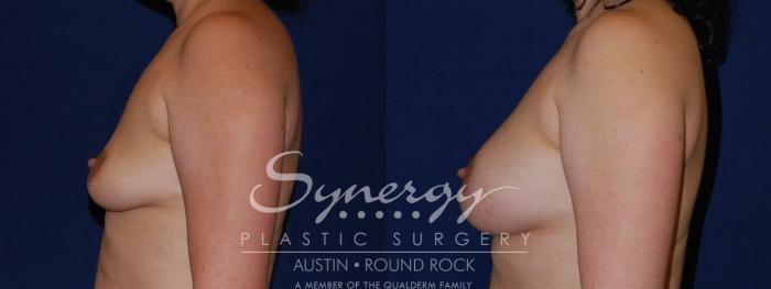 Before & After Breast Augmentation Case 121 View #5 View in Austin, TX