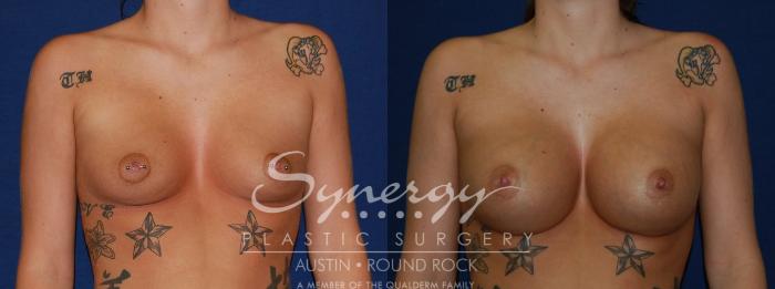 Before & After Breast Augmentation Case 124 View #1 View in Austin, TX