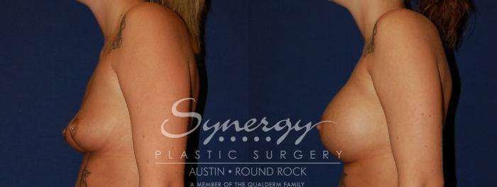 Before & After Breast Augmentation Case 124 View #2 View in Austin, TX