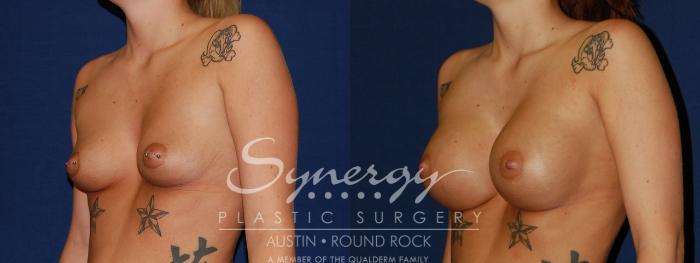 Before & After Breast Augmentation Case 124 View #3 View in Austin, TX
