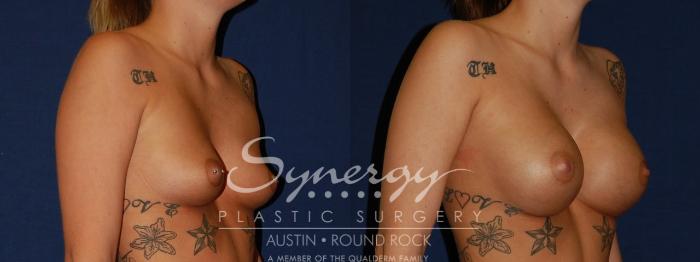 Before & After Breast Augmentation Case 124 View #4 View in Austin, TX