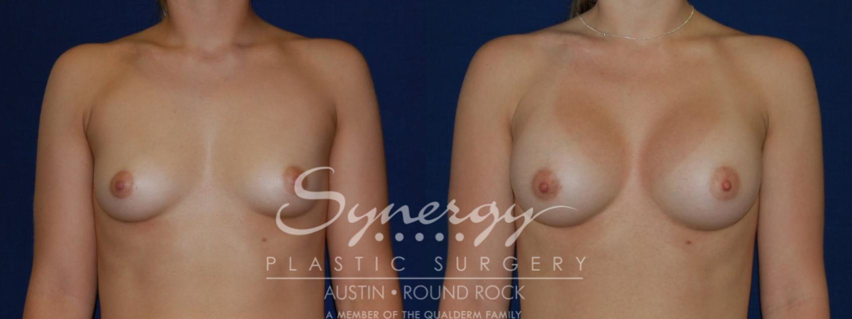 Before & After Breast Augmentation Case 135 View #1 View in Austin, TX