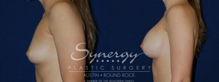 Before & After Breast Augmentation Case 135 View #2 View in Austin, TX