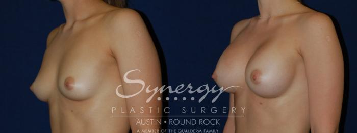 Before & After Breast Augmentation Case 135 View #3 View in Austin, TX