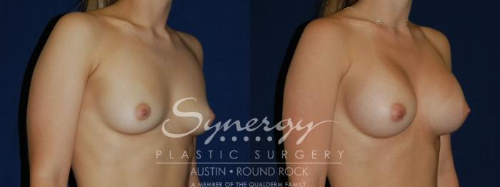 Before & After Breast Augmentation Case 135 View #4 View in Austin, TX