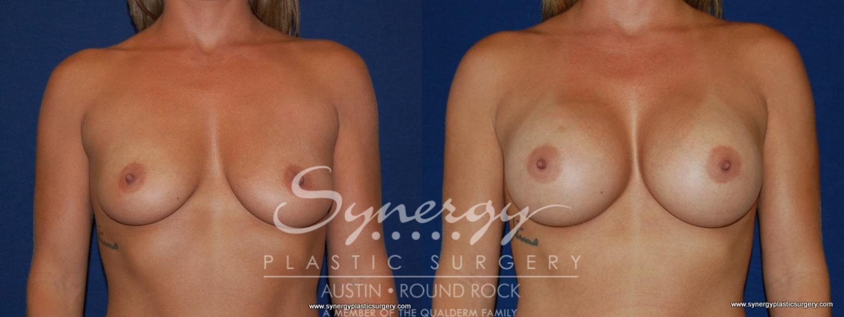 Before & After Breast Augmentation Case 141 View #1 View in Round Rock, TX