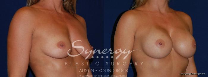 Before & After Breast Augmentation Case 141 View #2 View in Austin, TX