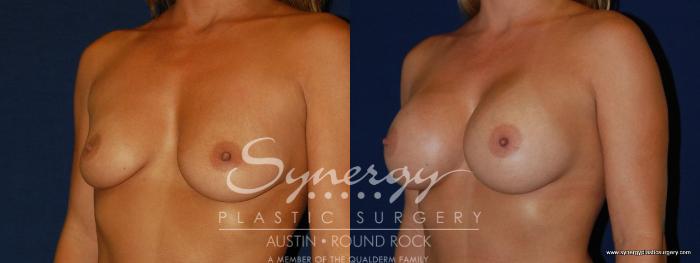 Before & After Breast Augmentation Case 141 View #3 View in Austin, TX