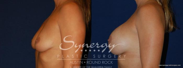 Before & After Breast Augmentation Case 141 View #4 View in Austin, TX