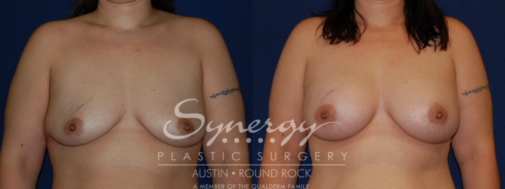 Before & After Breast Augmentation Case 142 View #1 View in Austin, TX