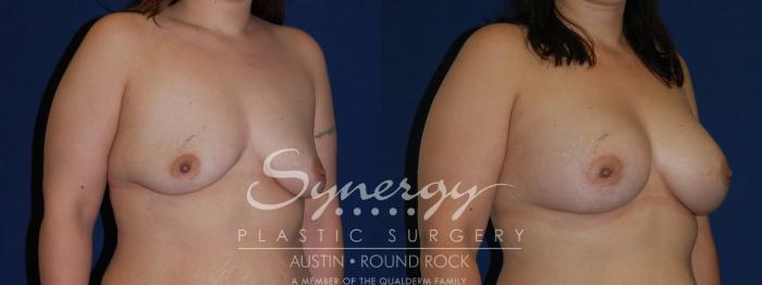 Before & After Breast Augmentation Case 142 View #2 View in Austin, TX