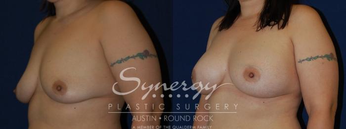 Before & After Breast Augmentation Case 142 View #3 View in Austin, TX