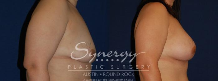 Before & After Breast Augmentation Case 142 View #5 View in Austin, TX