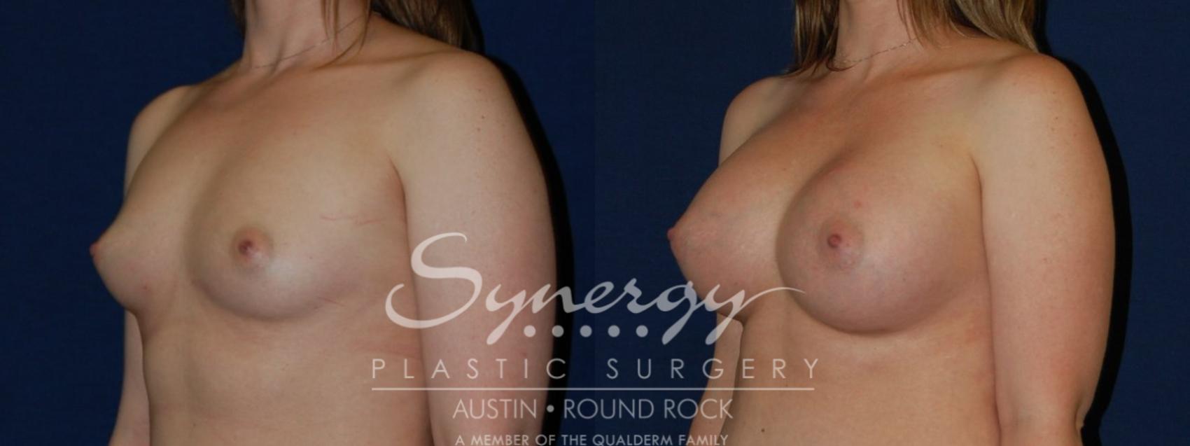 Before & After Breast Augmentation Case 143 View #1 View in Austin, TX