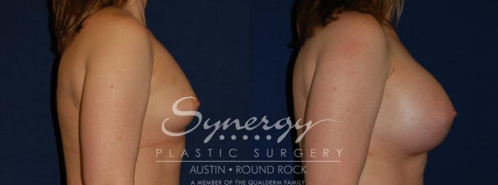 Before & After Breast Augmentation Case 143 View #2 View in Austin, TX